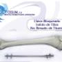 Clavos Bloqueados de Titanio Femur Tibia Humero