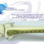 Placa Anatomica Femur Distal Tipo Liss Titanio Autobloqueada