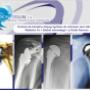 Protesis de Hombro Primaria Delta Global Advantage Fx johnson and Johson Depuy Synthess Origen Usa