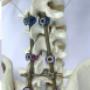 Sistema de Fijacion Posterior Columna Poliaxiales Titanio Johnson and Johnson Depuy Synthess