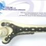 placa lcp anatomica humero distal titanio 3,5 mm