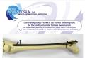 Clavos Bloqueados de Tibia Femur Humero PFN Gamma Retrogrado con