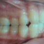 Estado inicial: apiñamiento y protrusión dental