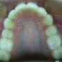 Vistal final maxilar superior
