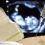Subido por visitante en 4/3/2018 - Amniocentesis eco-guiada
