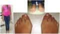HALLUX VALGUS JUVENIL