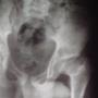 Subido por visitante en 5/10/2016 - Tratamiento de enfermedad de Leg Calves Perthes
