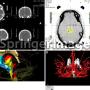 Biopsia cerebral.