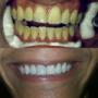 BLANQUEAMIENTO DENTAL IMAGEN DENTAL MARACAIBO