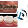 RESTAURACIONES ESTETICAS MARACAIBO IMAGEN DENTAL