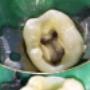Endodoncia