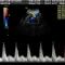 Doppler-Materno-Fetal