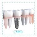 Implante Dental